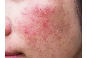 Bukan pakai air beras, ini trik bikin face mist penenang kulit iritasi dengan 1 jenis bunga