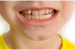 Tanpa tambahan kunyit, ini trik bunuh bakteri penyebab noda kuning pada gigi pakai 3 bahan alami