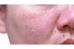 Tak perlu beli porepack lagi, ini cara kecilkan pori-pori agar wajah bebas minyak pakai 1 bahan masak