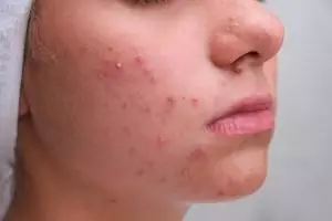 Bukan dengan susu, ini cara enyahkan jerawat agar tidak berbekas pakai 1 bahan pemanis