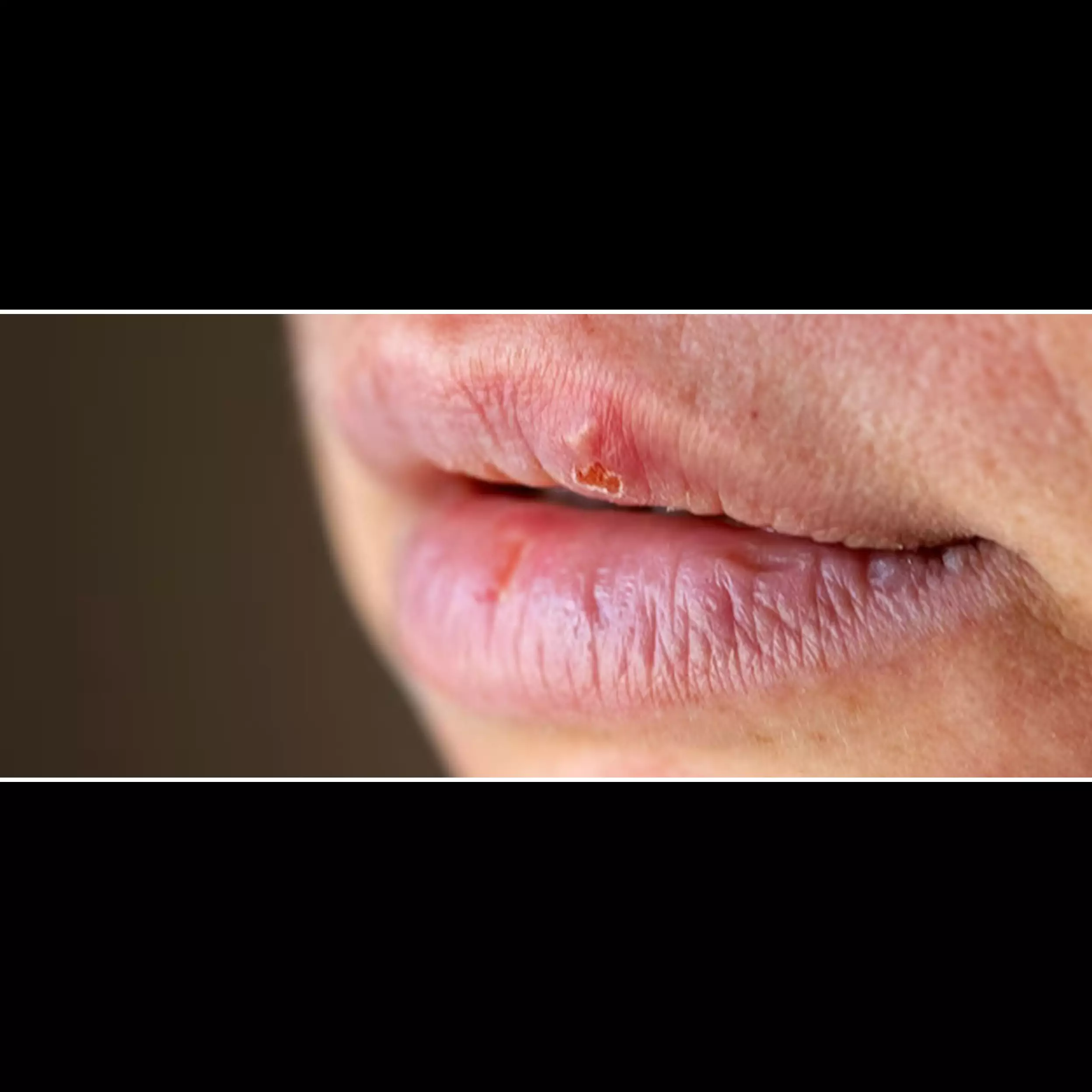 Bukan hanya bubuk kopi, ini cara atasi bibir kering dan retak pakai 1  bahan dapur