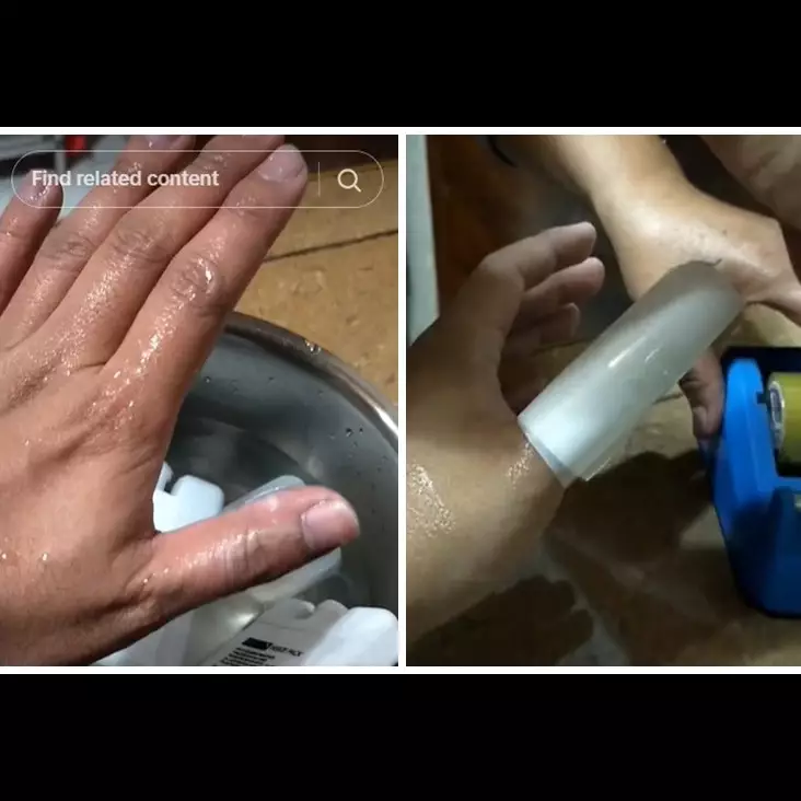 Tanpa pasta gigi, ini trik atasi kulit kena air atau minyak panas biar tak melepuh pakai 1 bahan dapur