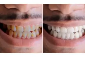 Tanpa tambahan stroberi dan baking soda, ini trik hilangkan kekuningan pada gigi pakai 3 bahan dapur