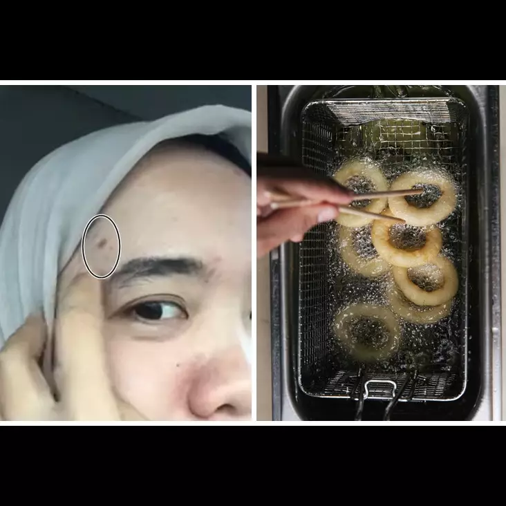 Trik mengatasi kulit wajah yang terciprat minyak panas supaya tak melepuh pakai 1 bahan dapur