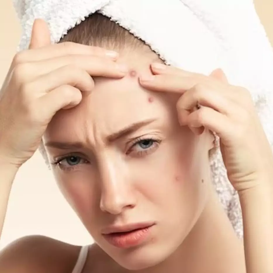 Jangan asal dipecahin, ini trik kempeskan jerawat meradang dalam semalam cuma pakai 1 jenis daun