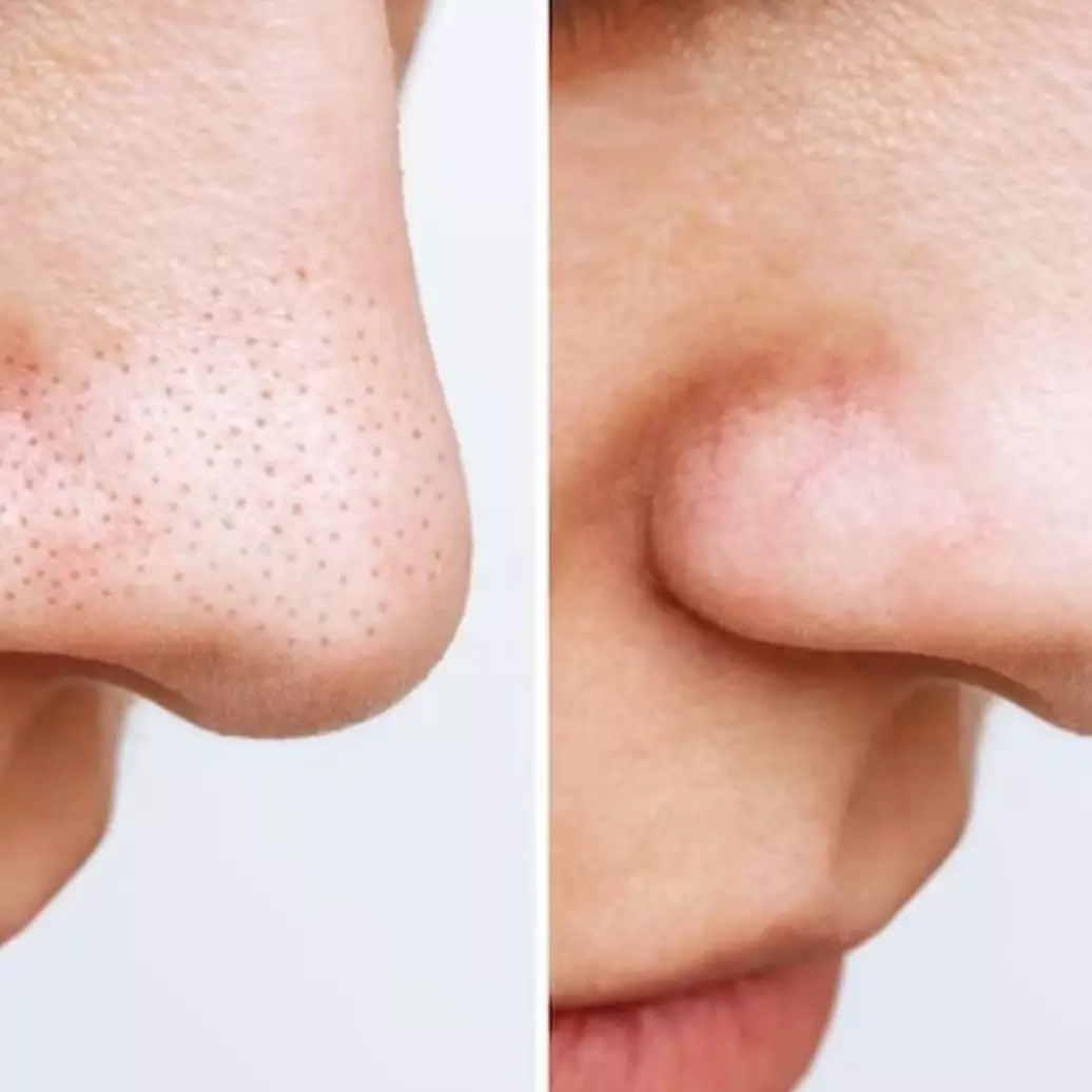 Jangan dioles pasta gigi, ini trik agar komedo hidung bersih tuntas pakai 2 bahan pemanis