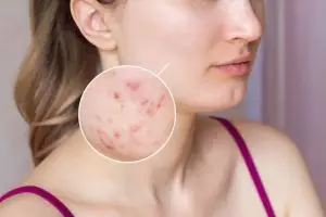 Tak perlu beli acne patch, ini trik redam munculnya jerawat agar tak berbekas pakai 2 jenis makanan