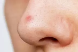 Bukan dengan putih telur, ini trik atasi komedo dan sel kulit mati pada hidung pakai 1 jenis minuman