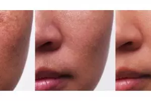 Tanpa tambahan lemon, ini trik bikin pori-pori tersumbat bersih total pakai 1 jenis minuman