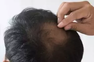 Tak hanya pakai minyak zaitun, ini trik tumbuhkan rambut botak pria dengan tambahan 1 jenis rempah