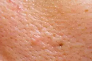 Nggak cuma pakai putih telur, ini cara kecilkan ukuran pori-pori wajah dengan tambahan 1 jenis tepung