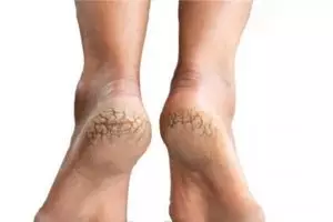 Tak perlu pedicure, ini trik cegah luka pada tumit kaki kering dan retak pakai 1 ekstrak kacang