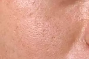 Tak hanya pakai putih telur, ini cara atasi pori besar pada wajah dengan tambahan 1 jenis buah-buahan