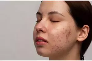 Tanpa lemon dan pisang, ini cara samarkan bekas jerawat menghitam pakai serum dari 1 jenis kulit buah