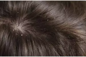 Bukan dioles jeruk nipis, ini cara hilangkan ketombe berkerak pakai hair oil dari 1 jenis daun