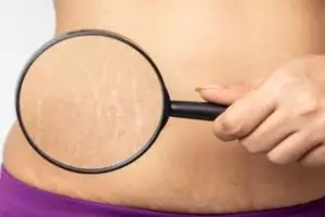 Bukan pakai kopi, ini trik cegah munculnya stretch mark di perut ibu hamil dengan 1 jenis minyak