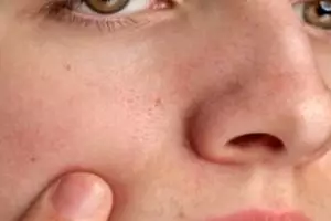 Tak perlu tambahan putih telur, ini cara samarkan ukuran pori wajah pakai 1 jenis tumbuhan herbal