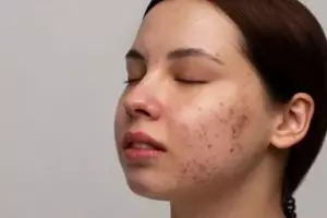 Bukan cuma pakai lemon, ini trik atasi flek hitam bekas jerawat dengan tambahan 1 jenis bahan dapur