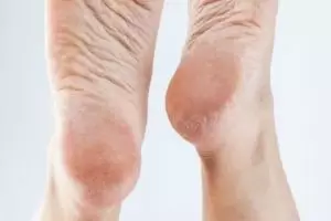 Tanpa minyak zaitun, ini trik bikin tumit retak jadi halus bak kulit bayi pakai 1 jenis tanaman herbal