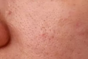 Wajah jadi mulus bebas komedo, begini trik bikin ukuran pori lebih mengecil pakai 2 jenis buah-buahan