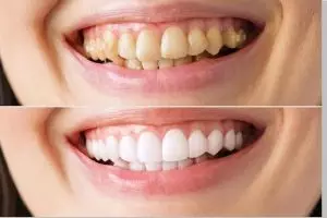 Tanpa tambahan baking soda, ini trik memutihkan noda kuning pada gigi hanya pakai 1 bahan rempah