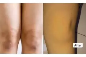 Trik memutihkan lutut gelap pakai 1 jenis rempah dapur, kulit cerah merata tanpa produk bleaching