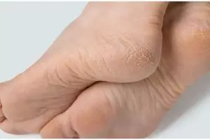 Hasilnya terlihat dalam satu malam, ini trik haluskan tumit kaki retak menghitam pakai 2 bahan dapur