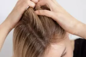 Tak cuma lemon, ini cara atasi ketombe kering dan kepala gatal dengan tambahan 1 jenis bahan makanan