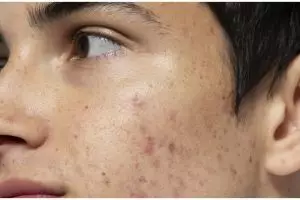 Tanpa gunakan krim pemutih, ini trik memutihkan wajah kusam dan berflek hitam pakai 1 bahan makanan