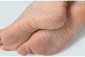 Tanpa tambahan baking soda, ini cara menghaluskan telapak kaki kasar auto mulus pakai 1 pembersih gigi