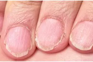 Bukan gunakan baking soda, ini trik atasi jamur kuku menguning agar kembali pulih pakai 1 bahan dapur