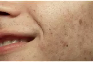 Tanpa tambahan lemon, ini trik singkirkan flek hitam di wajah pakai 2 bahan alami