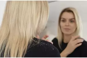 Tak perlu gunakan jeruk nipis, ini trik hilangkan ketombe agar nggak balik lagi pakai 1 bumbu dapur