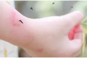 Tanpa minyak zaitun, ini trik putihkan noda hitam di kaki akibat gigitan nyamuk pakai 1 bubuk minuman