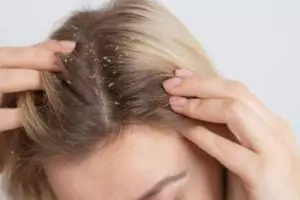 Nggak hanya pakai minyak zaitun, begini cara hilangkan ketombe kering dengan tambahan 1 bahan minuman