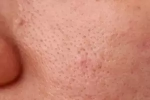 Tanpa teh hijau, ini cara atasi minyak berlebih di wajah penyebab pori besar pakai 2 jenis buah-buahan