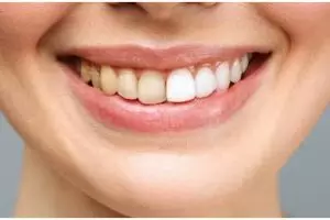 Tanpa gunakan baking soda, ini trik mencegah gigi kuning akibat plak pakai 1 bumbu dapur