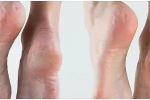 Bukan pakai garam dan petroleum jelly, ini trik atasi tumit kaki retak menghitam pakai 1 bumbu dapur