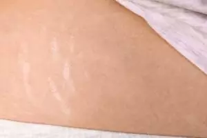 Kulit jadi lebih mulus, begini cara pudarkan stretch mark setelah diet cuma dengan 1 bahan minuman