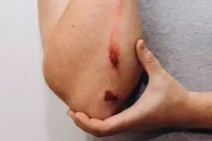 Nggak perlu laser mahal, begini cara pudarkan bekas luka di kulit pakai 2 jenis rempah