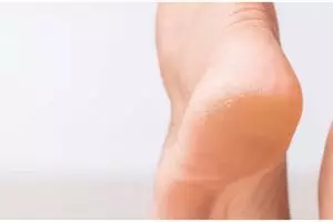 Tak pakai lemon, ini cara rontokan kulit mati penyebab tumit kaki retak dengan 1 bahan pemanis