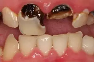 Tak perlu garam, ini trik rontokkan plak hitam menempel di gigi agar auto bersih pakai 1 jenis rempah