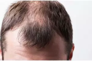 Tanpa obat penumbuh, ini cara mengatasi rambut botak akibat perubahan hormon hanya pakai 1 jenis buah