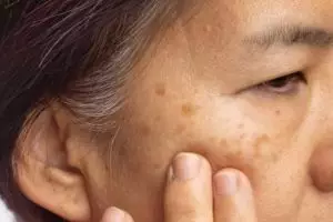 Tak cuma putih telur, ini cara pudarkan kerutan dan flek penuaan dengan tambahan 1 jenis buah-buahan