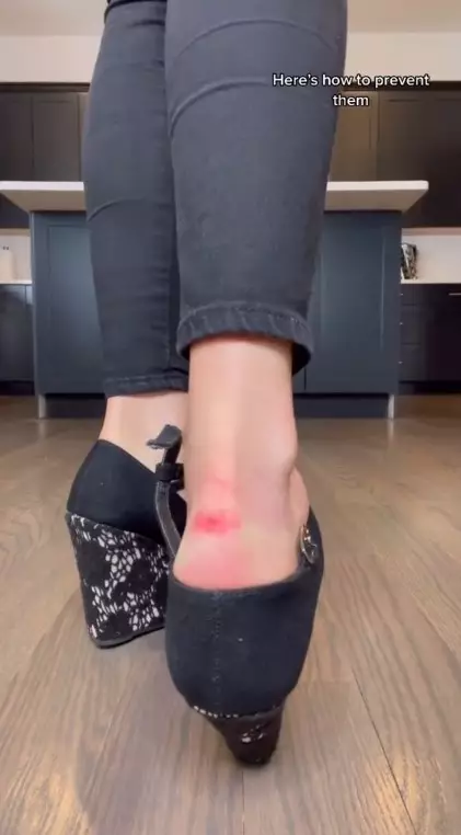 kaki lecet saat pakai sepatu © TikTok