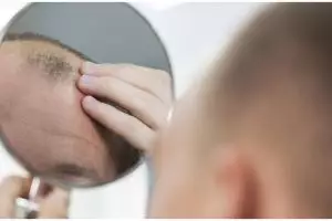 Tak pakai lidah buaya, ini trik meningkatkan pertumbuhan rambut botak hanya dengan 1 bubuk minuman