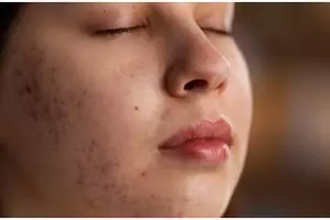 13 Rekomendasi skincare penghilang bekas jerawat di bawah Rp 250 ribu, wajah mulus tanpa noda hitam