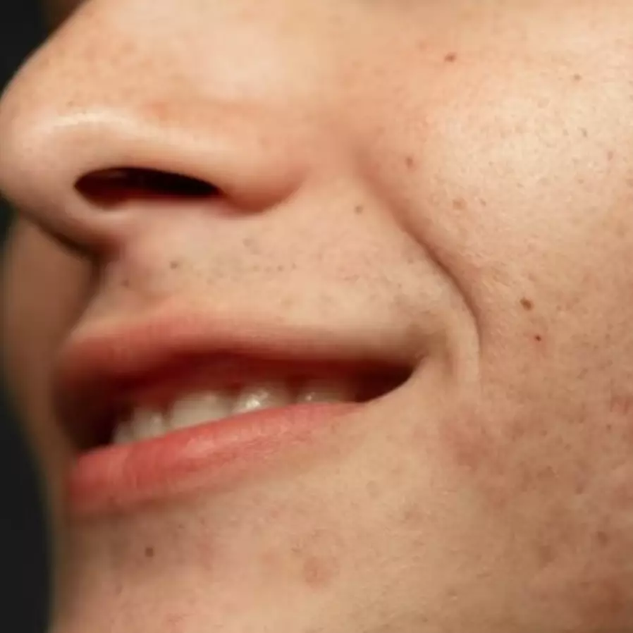 Cerah tanpa suntik putih, ini trik hilangkan noda hitam di wajah kusam pakai 1 umbi-umbian