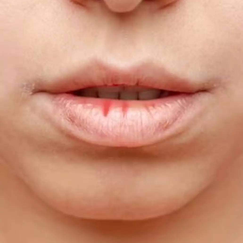 Kembali merah alami tanpa petroleum jelly, ini cara atasi bibir kering dan kusam pakai 1 jenis buah