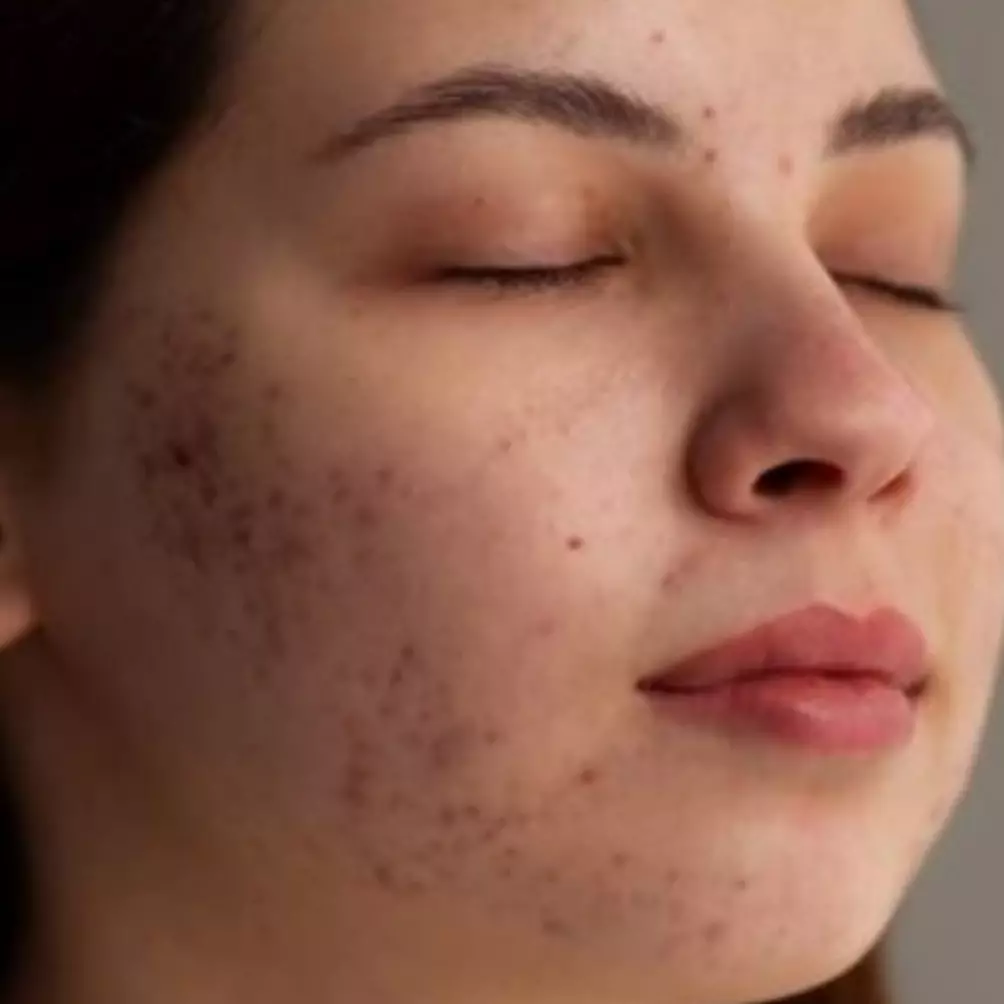 11 Rekomendasi skincare acne kandungan tea tree oil harga mulai 27 ribu, wajah mulus bebas jerawat